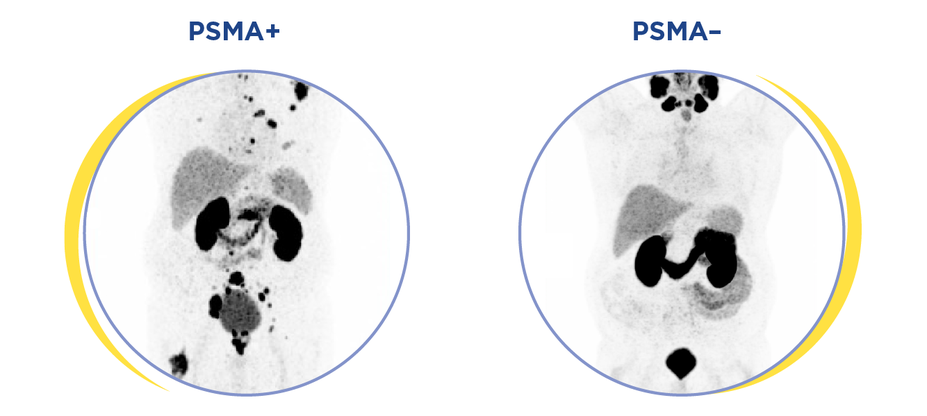 PSMA PET scans showing PSMA+ example and PSMA- example